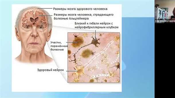 Взаимосвязь DLB с белками альфа-синуклеином: понимание основы заболевания
