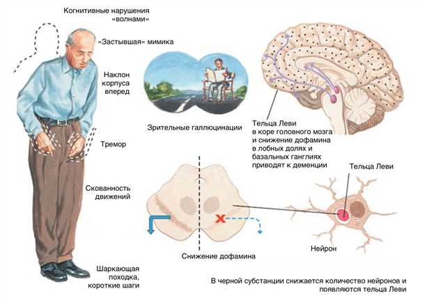 Деменция с нервно-клеточными включениями (Dementia with Lewy Bodies).