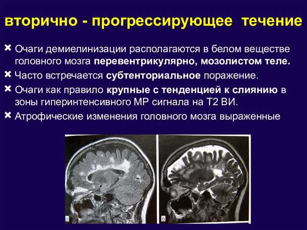 Демиелинизация при метаболических расстройствах у детей - причины, симптомы и возможности лечения Демиелинизация при метаболических расстройствах у детей.