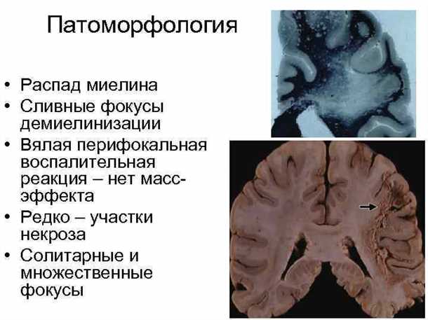 Влияние окружающей среды на возникновение демиелинизации