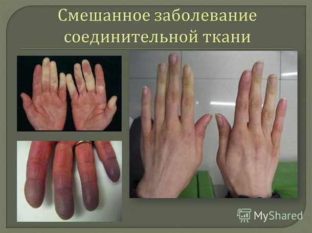 Диагностика изменений в оболочках нервных волокон при системных заболеваниях соединительной ткани