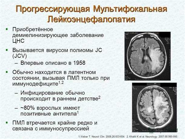 Последствия и осложнения демиелинизации