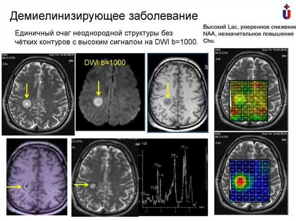 Воспалительный процесс и его влияние на миелин