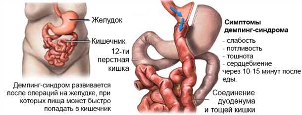 Каковы причины демпинг-синдрома?