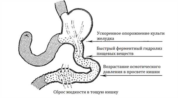 Демпинг-синдром: что это такое и каковы его причины?