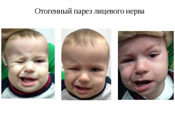 3. Ослабление мускулатуры