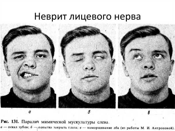 Детский парез и паралич лицевого нерва.
