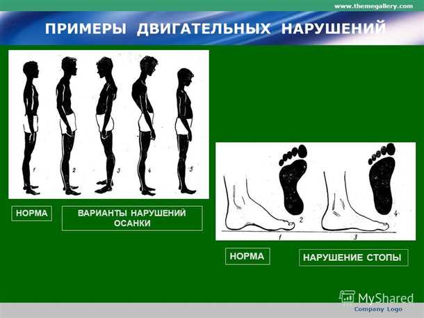 Детский синдром нарушений двигательной активности.