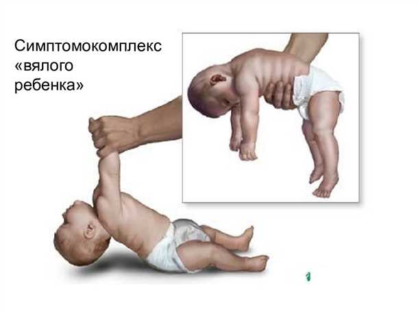 Детский синдром нарушений моторно-чувствительного развития.