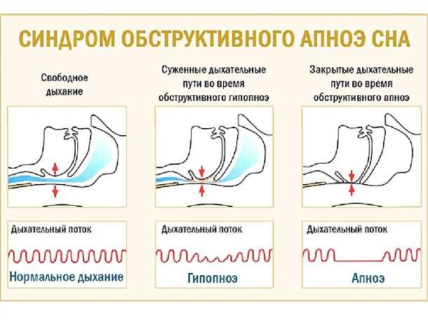 Детский синдром обструктивного апноэ сна.