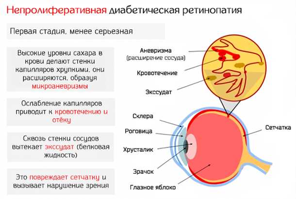 2. Лазерная коагуляция