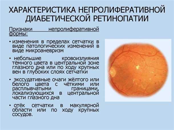 Главная причина снижения зрения при диабете