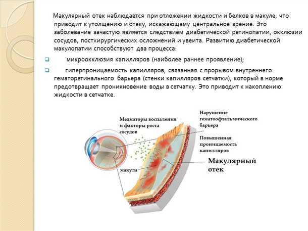 Диабетический макулярный отек