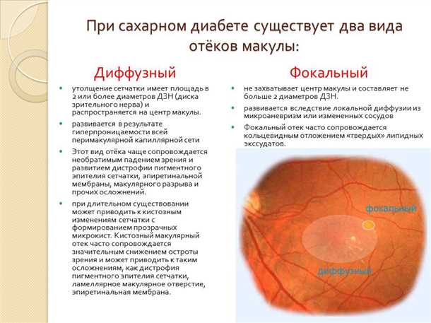 Диабетический макулярный отек — главная причина снижения зрения при диабете Диабетический макулярный отек — ДМО — главная причина снижения зрения при диабете