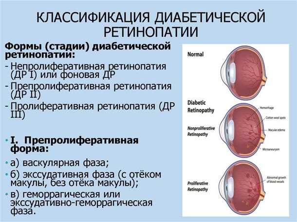 Диагностика диабетической ретинопатии — какие методы определят эту болезнь глаза?