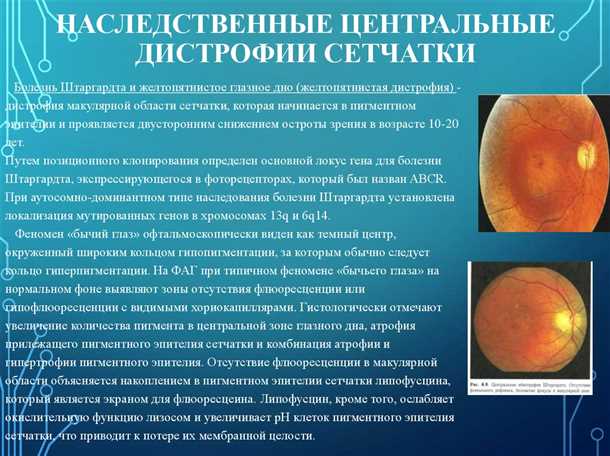 Диагностика ВМД — какие методы точно определят эту болезнь сетчатки глаза и её стадию?