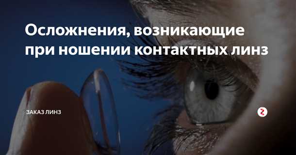 Мягкие линзы