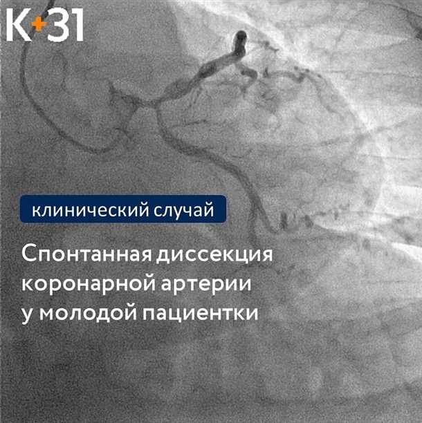 Диссекция сосудов головного мозга: клинические аспекты и подходы к лечению.