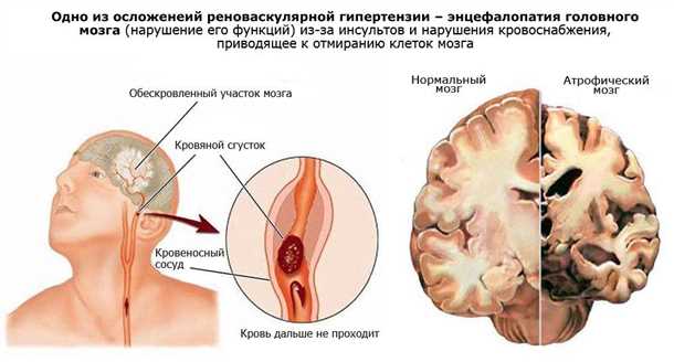 Ограниченные формы заболевания