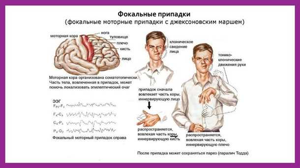 Эпилепсия и судорожные синдромы: патогенез, симптомы и лечение.