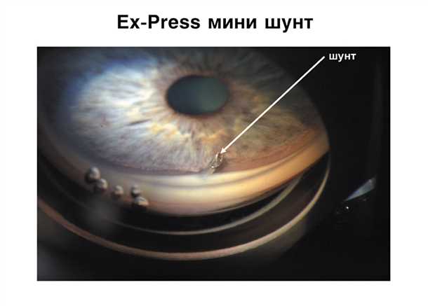 Преимущества использования Ex-press мини-шунта перед аналогами