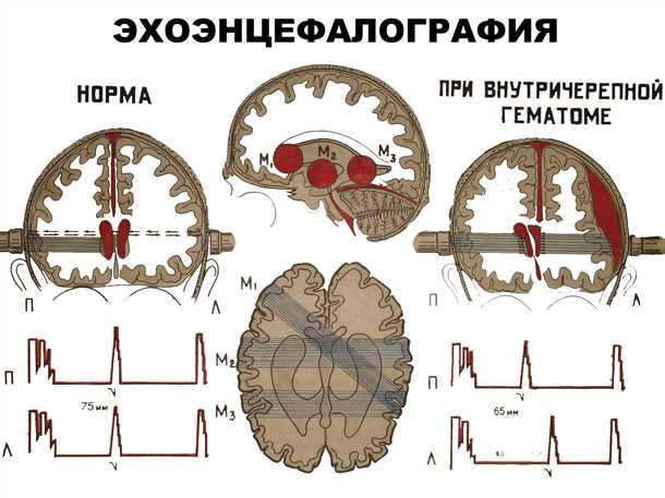 Эхоэнцефалография в диагностике сосудистых заболеваний головного мозга.