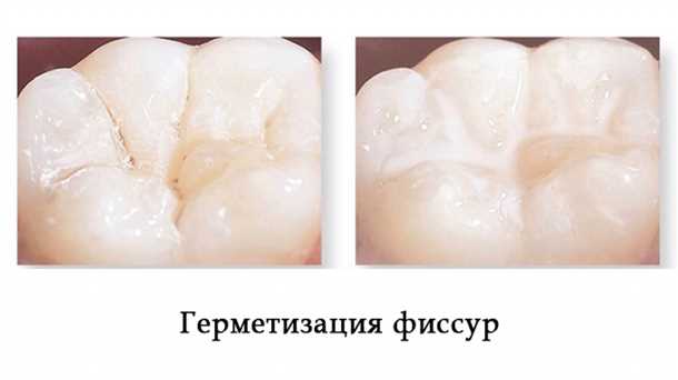 Фиссура зуба: что это такое и как лечить | Медицинская Энциклопедия