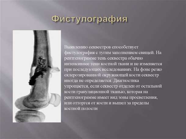 Фистулография свища: после процедуры