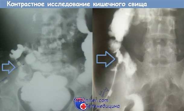Фистулография свища: основные понятия