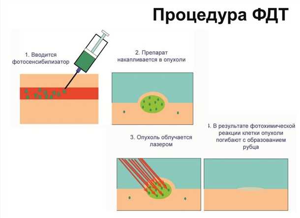Побочные эффекты и осложнения Фотодинамической терапии