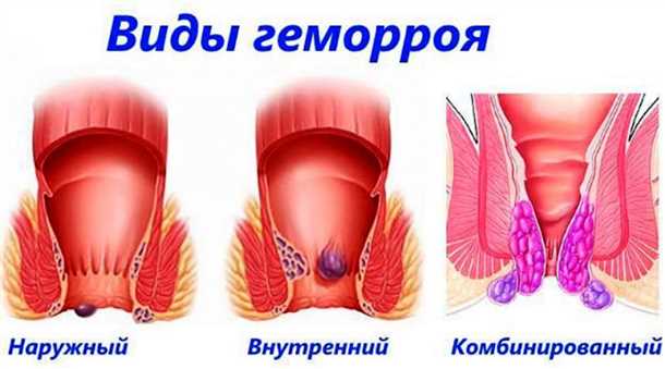 Как диагностировать геморрой