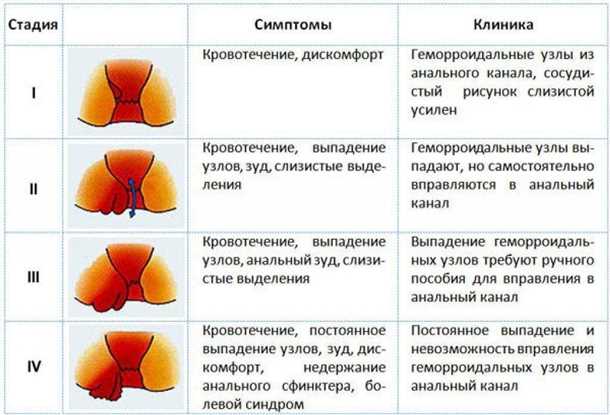 Хирургическое вмешательство при геморрое