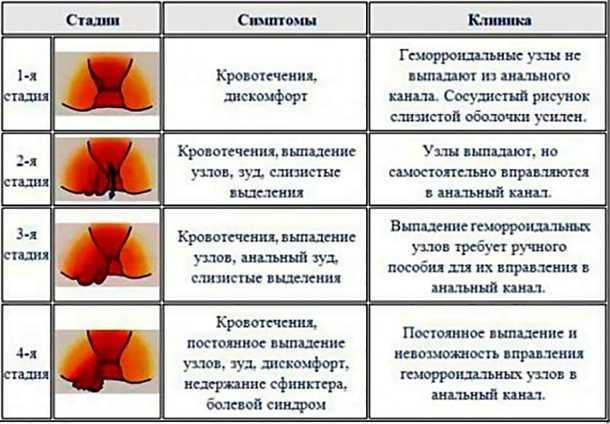 Внешний геморрой