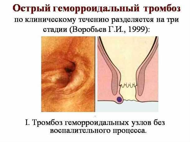 Внутренний геморрой