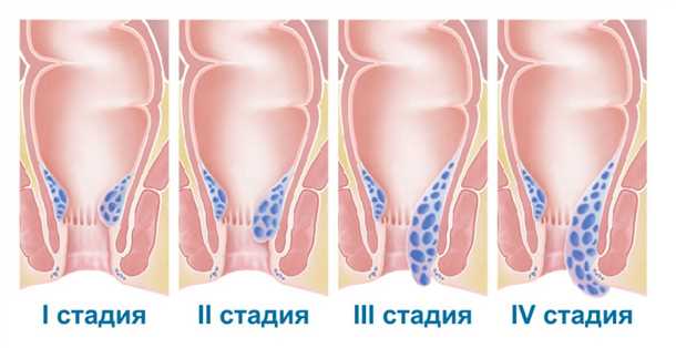 Хирургическое вмешательство при геморрое