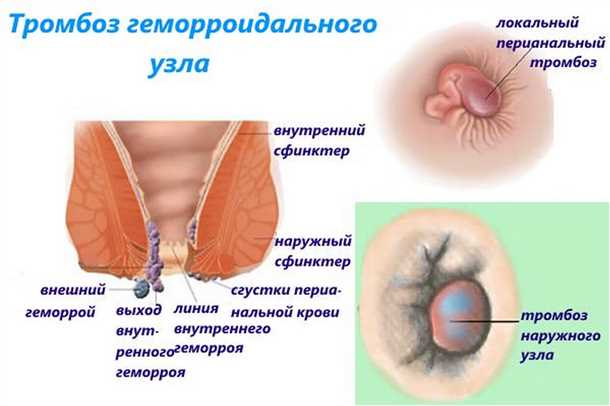 Профилактика геморроя: основные рекомендации