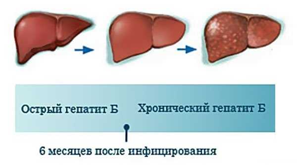 Диагностика гепатита острого