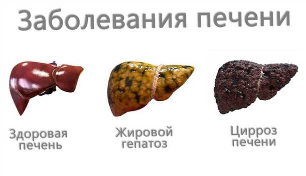 Профилактика гепатоза