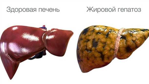 Лечение гепатоза