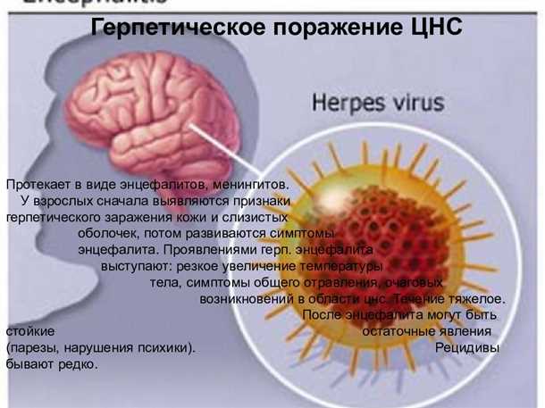 Герпесвирусные инфекции нервной системы.