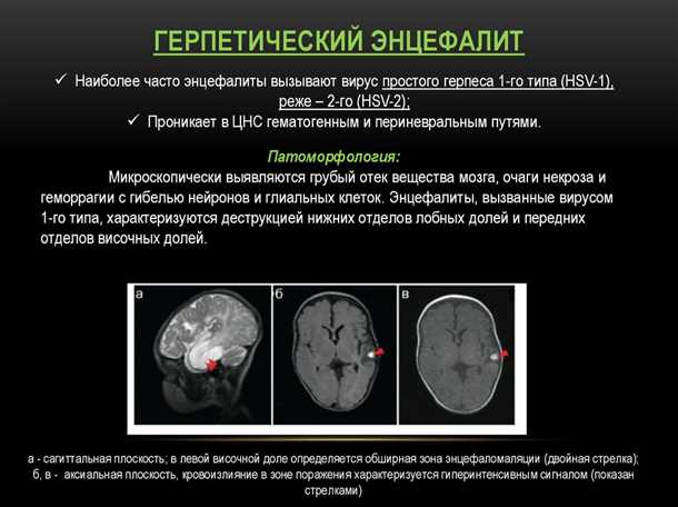 Последствия герпетического энцефалита