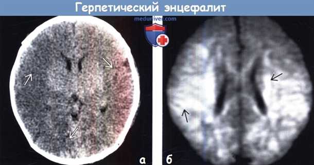 Причины возникновения вирусного воспаления головного мозга