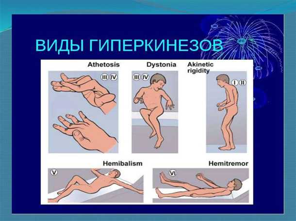 Гиперкинезы: классификация, симптомы и реабилитация.