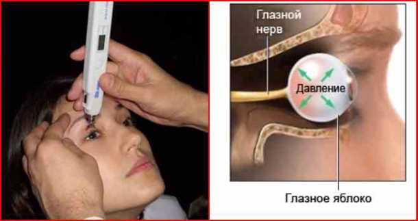 Симптомы повышенного глазного давления