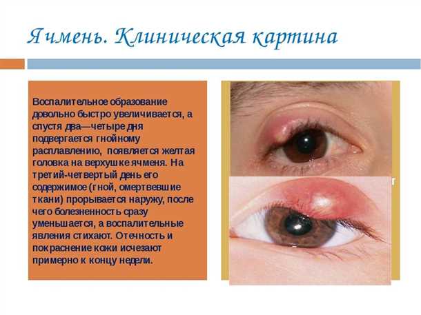 1. Сильное покраснение глаз