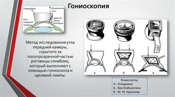  Основные преимущества метода гониоскопии