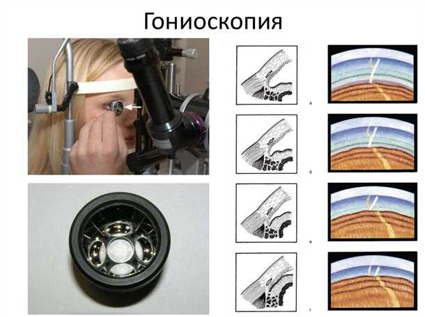 Гониоскопия: что это такое?