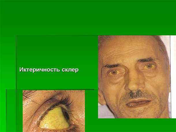 4. Витаминный дефицит