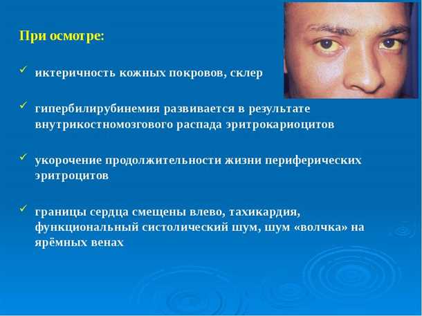 Как диагностировать иктеричность