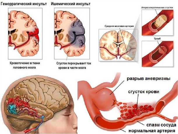 Инсульт (Цереброваскулярный инсульт)